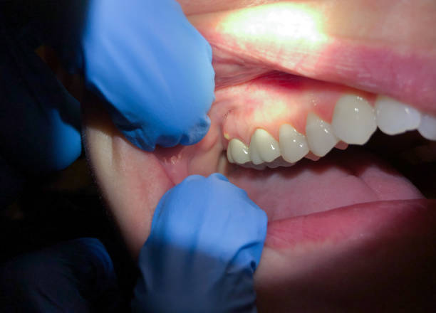 Best Emergency Treatment for Toothache in Fayetteville, AL
